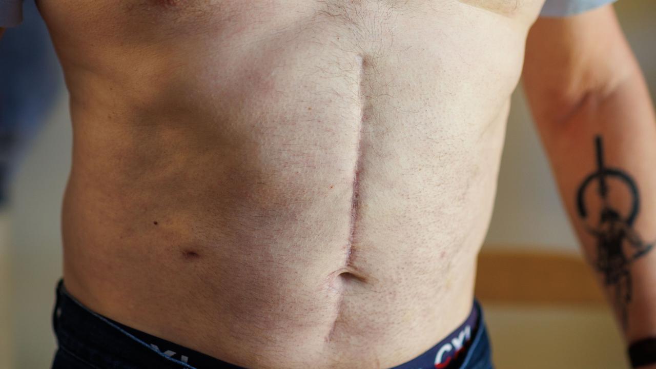 Pancreatic cancer patient Ron