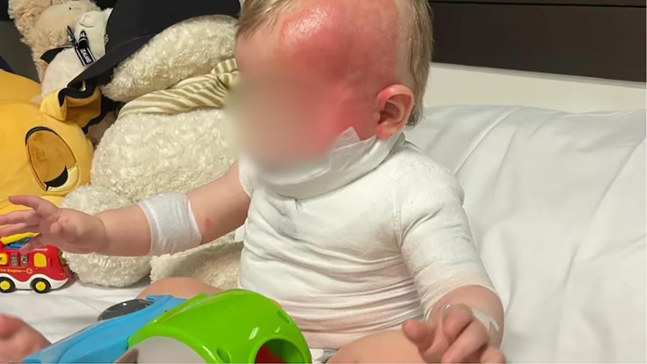 BABY ATTACKED WITH HOT COFFEE AUGUST 2024